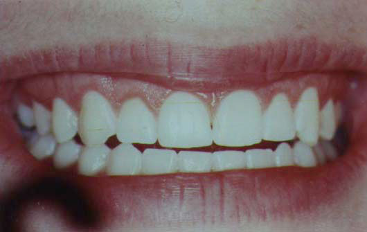 Inadaquate "Normal" Gum Recession - After