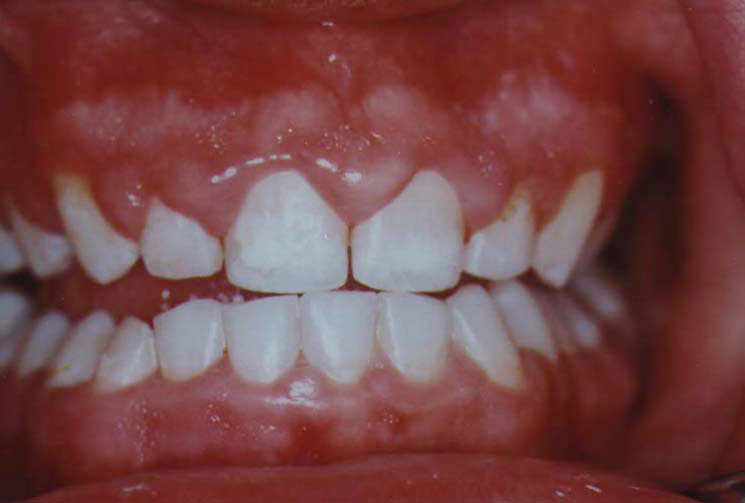 Overgrown Gums From Mouth Breathing